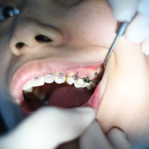 person with silver teeth braces